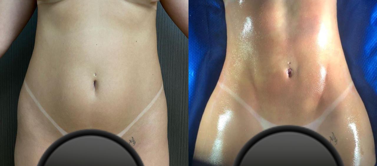 A Viih Tube mostra seu corpo e mostra que os resultados da Lipo LAD estão voltando!